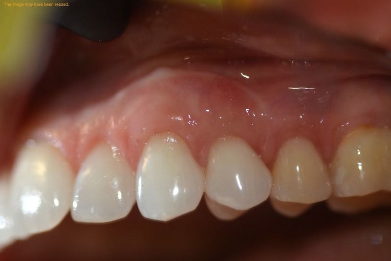 Picture of Teeth After Graft