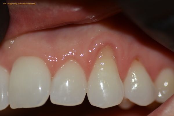Picture of Teeth Before Graft