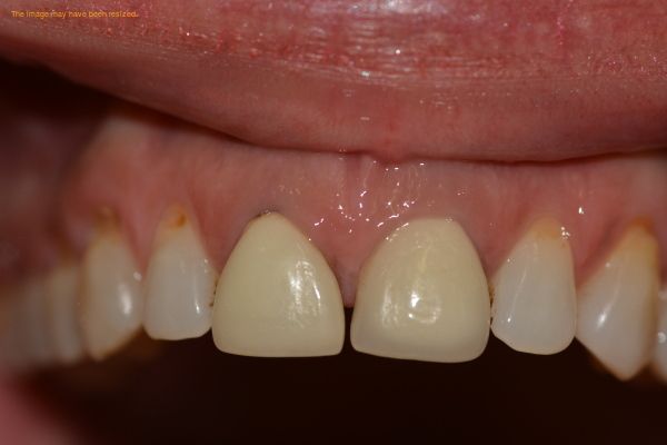 Dental Implant Kamloops