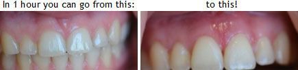 Picture of teeth before and after results of crown lengthening