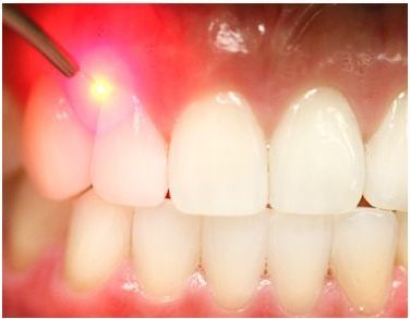 Laser Periodontal Hygiene