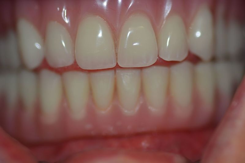 Small teeth after implants
