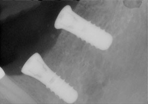 x ray of teeth implants